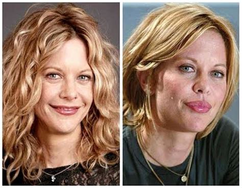 Worst Celebrity Facelifts