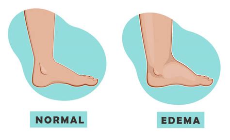 Edema Definitions, Causes and Assessment