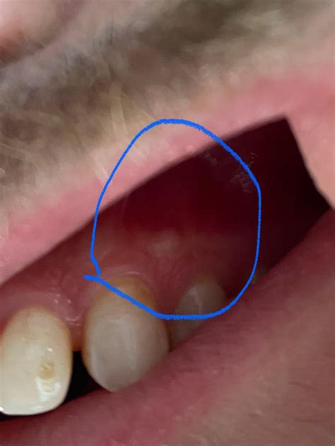Solid lump forming above tooth : r/askdentists