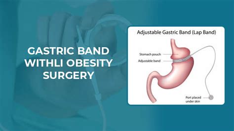 Gastric Band - LI Obesity Surgery