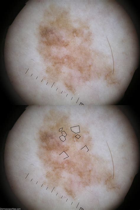 Dermoscopy Atlas | Diagnosis Detail