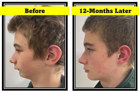 twin block orthodontics riverina dental albury