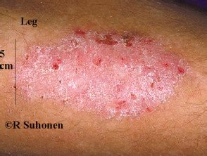 imagenes de liquen simple dermatlycom el sitio de tu piel