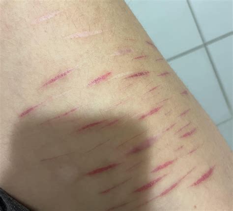 [TW SH SCARS!] How long will these take to turn white? : r/scars