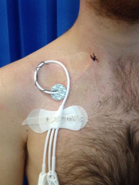 hickman  whats   anthony nolan