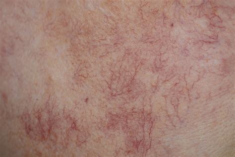 Face veins: What causes them and how to get rid of them.