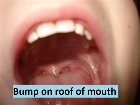 Bump On Roof Of Mouth, What Is The Cause? » 2026