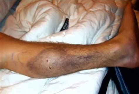 rattlesnake bites hunter chad cross montgomery ala resident saves