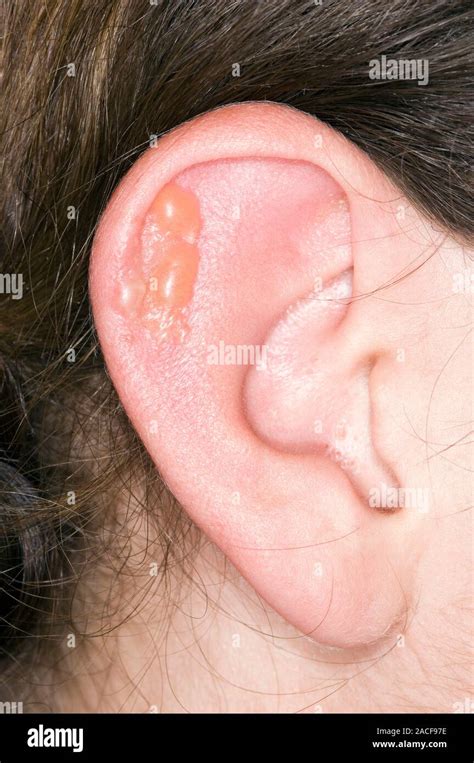 Herpes simplex lesion on the pinna of a man's ear. Herpes simplex is a ...