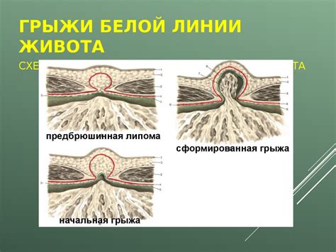 Лечение грыж - презентация онлайн