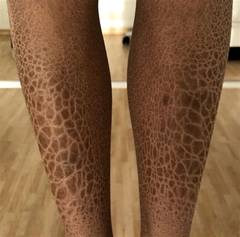 Medical Student Lives with X-Linked Congenital Ichthyosis » Scary Symptoms