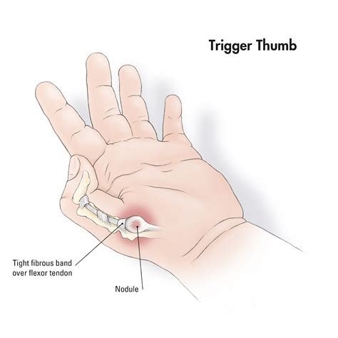 Doctors answer patients asking why is my thumb shaking so much 7