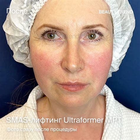 Smas-лифтинг Ultraformer IV в Москве, цены в клинике Beauty Trend