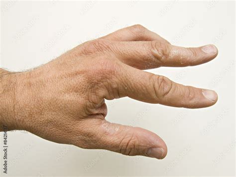 Hand Neurodermitis 584 Stock-Foto | Adobe Stock