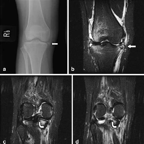 marginal fractures   medial tibial plateau