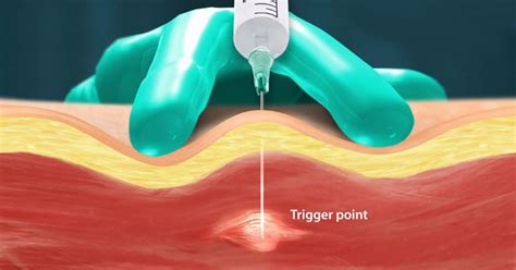 trigger point injections overview procedure
