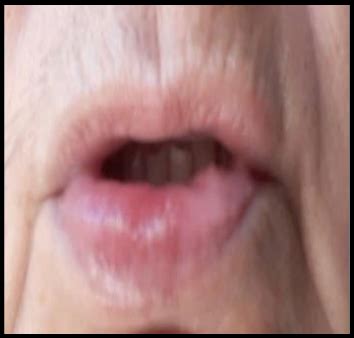 Swollen lip accompained with crusts and erythema on labial mucosa