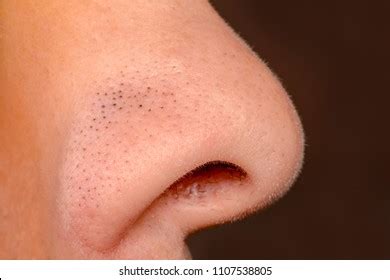 1,635 Comedo 이미지, 스톡 사진 및 벡터 | Shutterstock