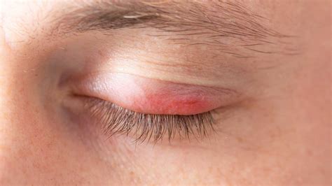 treating swollen eyelids  essential guide  relief swollen eyelid
