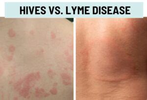 Hives (Urticaria) vs. Rash: Pictures and Differences