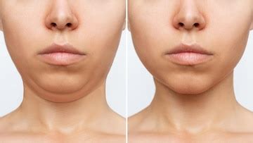 Premium Photo | Liposuction of the double chin. Woman's face with chin ...
