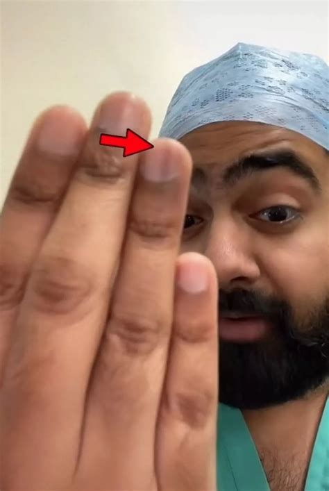 Discoloured fingernail symptom you should get checked out, according to