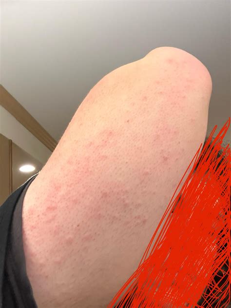 Any ideas what this is? There has been beg bugs going around my dorm