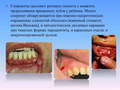 Микрофлора полости рта. Микробиология - online presentation