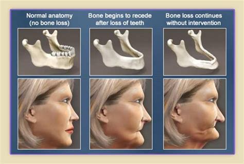 What causes bone loss in your jaw? | Dental implants cost, Dental life ...