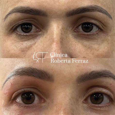 Blefaroplastia Sem Corte Antes E Depois