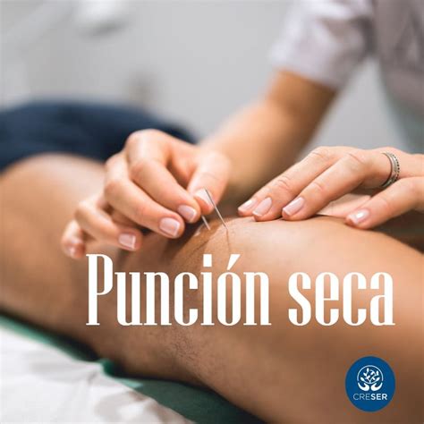 SESIÓN DE PUNCIÓN SECA » Kinesiología Fisioterapia