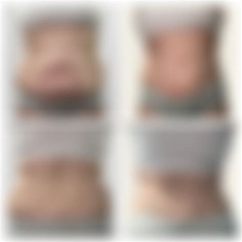 Before & After Sonobello TriSculpt EX : r/PlasticSurgery