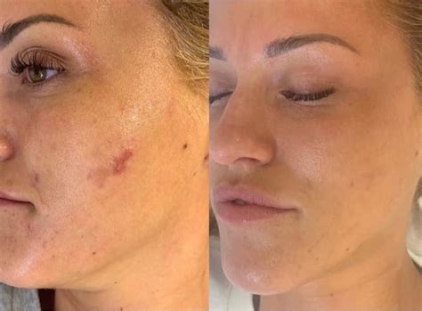 Blush Spa | Facials | Microneedling | Chemical Peels | Guelph