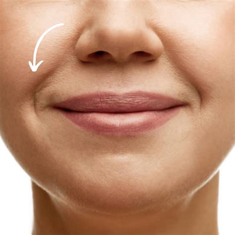 achieve smoother skin  nasolabial folds treatment