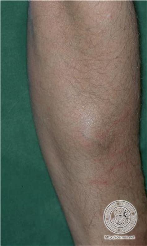 ЛИПОМА * My dermatology