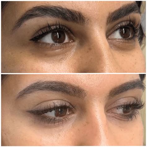 nctf  eye skin booster treatment london bright eyes