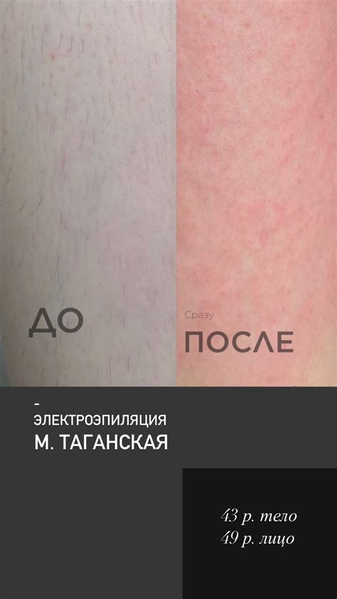Электроэпиляция в Москве в клинике Effect Epil