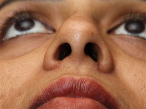 Rhinophyma Before & After Photos - Dr. Solomon