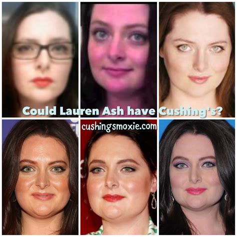 buffalo hump moon face cushing syndrome before and after 9