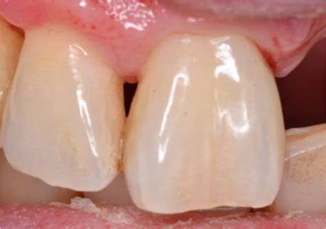 Dental Update - Contouring an abutment tooth to aid placement of a ...