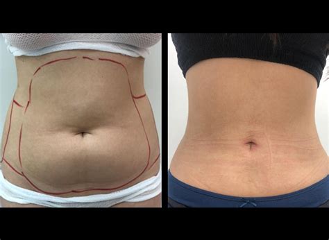 Mini Lipo Laser Antes E Depois - Lipoláser | Dr. Pablo Serrano – Estética & Laser