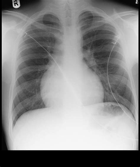 Hypertrophic obstructive cardiomyopathy: a potential cause of loss of
