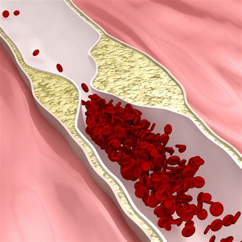 how to know if you have plaque in arteries