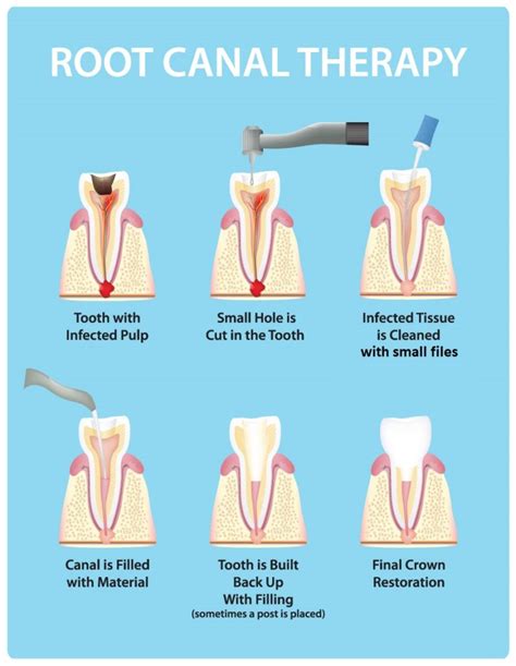 root canal therapy cameo dental family dentistry  rosemount minnesota
