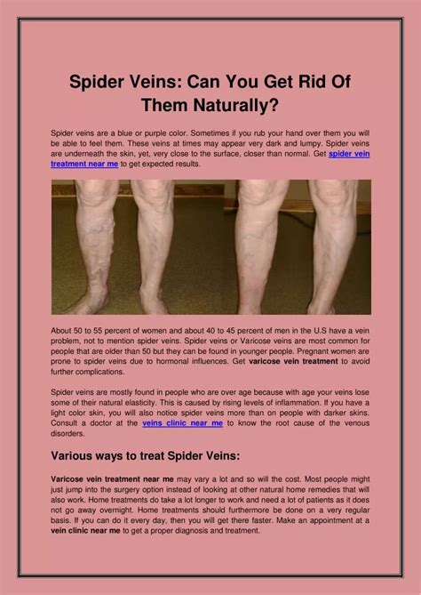 PPT - Spider Veins Can You Get Rid Of Them Naturally PowerPoint ...
