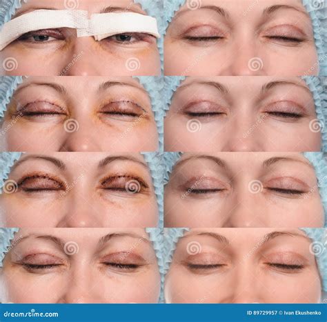 Blepharoplasty Of The Upper Eyelid. Stock Photo | CartoonDealer.com