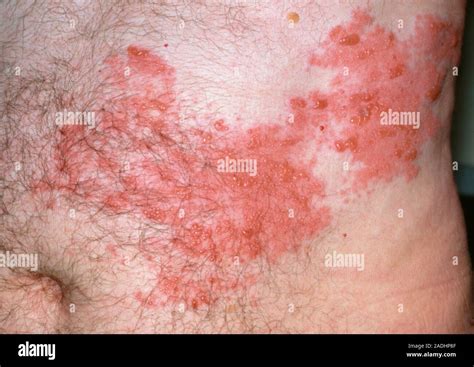 herpes zoster  shingles   stomach region   man  show