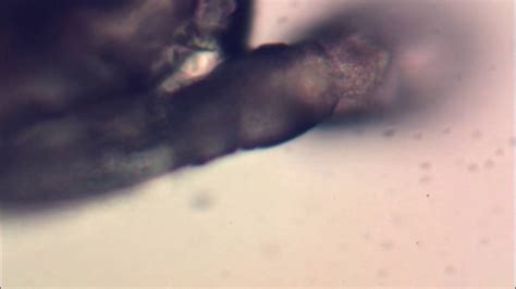 Живой паразит Демодекс под микроскопом, Human Demodex Follicles Mites ...