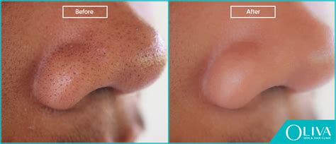 Severe Blackheads Removal