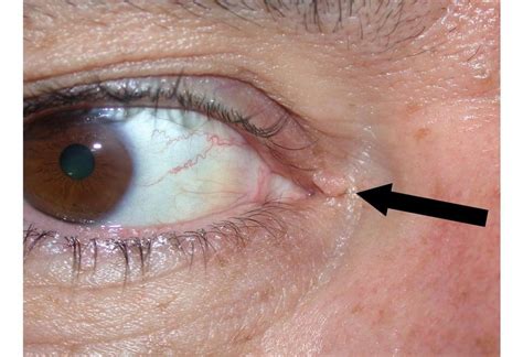 eyelid skin cancer mivision
